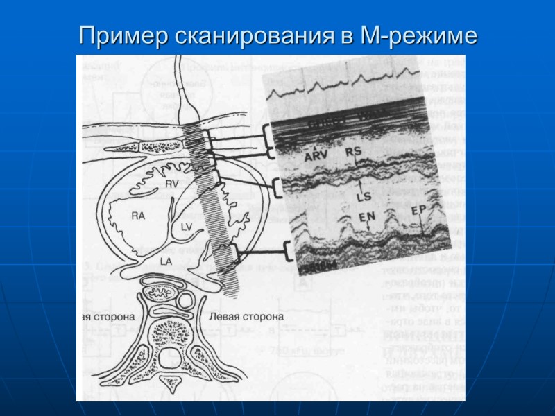 Пример сканирования в М-режиме Пример сканирования в М-режиме